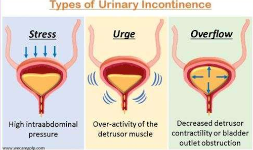 urinary incontinence treatment before after mississauga oakville